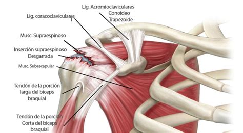 Radiografía de un hombro con signos de tendinitis del manguito rotador.