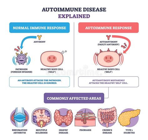Esquema sobre la respuesta autoinmune ante la ingesta de gluten en individuos genéticamente predispuestos (HLA-DQ2/DQ8) y el daño en las vellosidades intestinales.