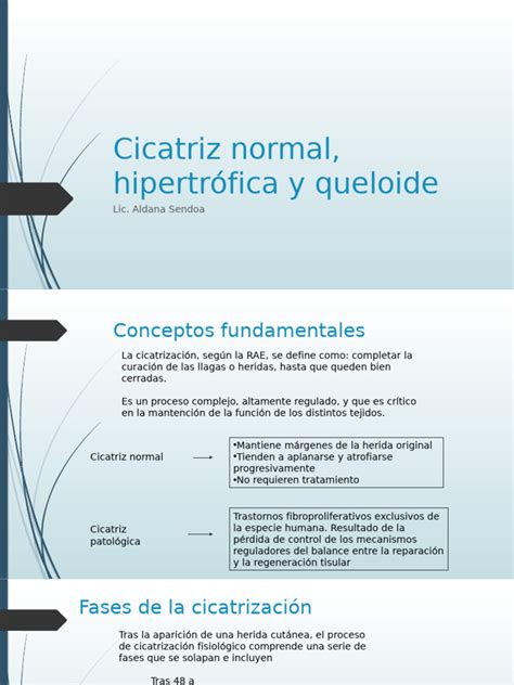 Infografía comparando cicatriz normal, cicatriz hipertrófica y queloide