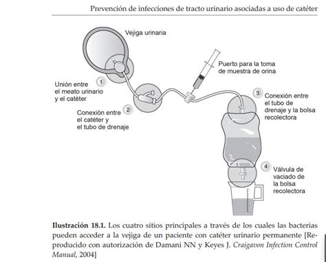 Ilustración detallada de un catéter tipo condón y su sistema de conexión a una bolsa colectora.
