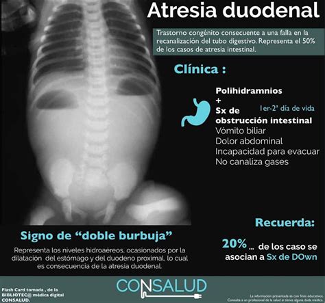 Signo de la doble burbuja en radiografía abdominal, indicativo de atresia duodenal.