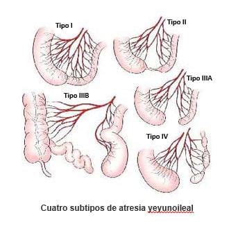 Esquema mostrando los diferentes tipos de atresia yeyunoileal (Tipos I, II, III, IV).
