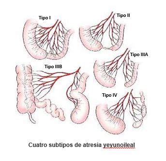 Representación esquemática de la atresia intestinal tipo IIIB (apple peel) mostrando la disposición del intestino alrededor de una única arteria mesentérica.