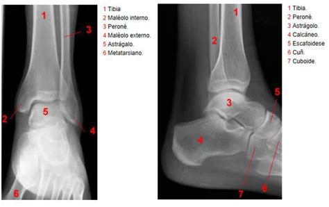 Radiografía de un tobillo con esguince.