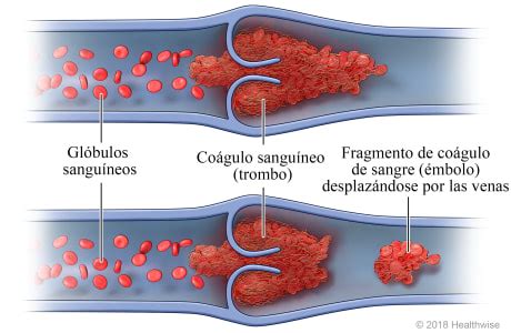 Representación gráfica de un coágulo sanguíneo en una vena de la pierna.