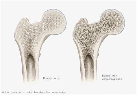 Infografía comparando la estructura de un hueso sano y uno con desgaste, destacando el papel del colágeno.