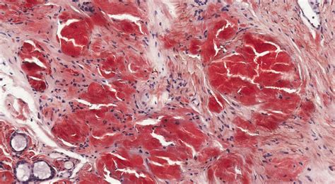 Microfotografía de una muestra de raspado cutáneo con tinción donde se observan hifas cortas y células redondeadas, configurando la imagen clásica de 