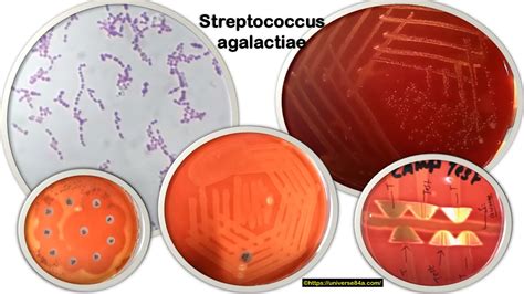 Gráfico comparativo de la prevalencia de colonización por Streptococcus agalactiae según el método de detección utilizado