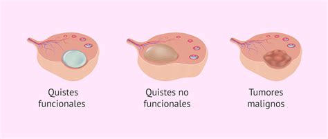 Representación gráfica de un ovario con múltiples quistes foliculares, característica del SOP.